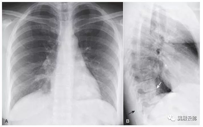 X线侧位胸片的5个关键区域